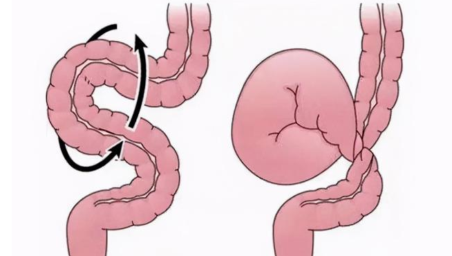 肠套叠ct图像_肠套叠的ct三大典型症状_肠套叠ct图