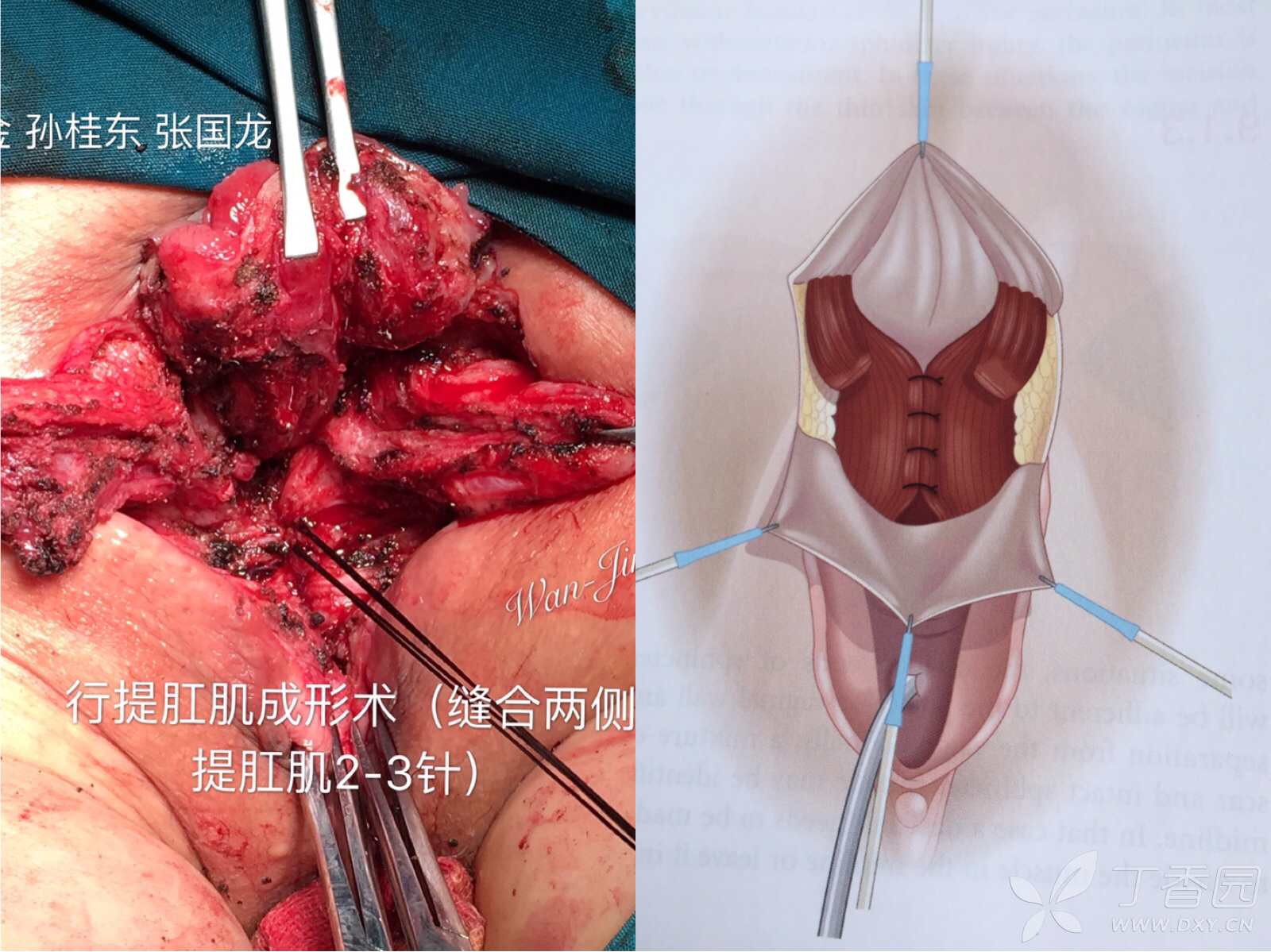 肛门被大便_男友插肛门 大便失禁_大便失禁肛门袋