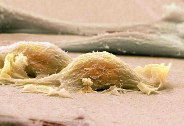 血液感染有哪些症状_血液感染的症状图片_血液感染的图片