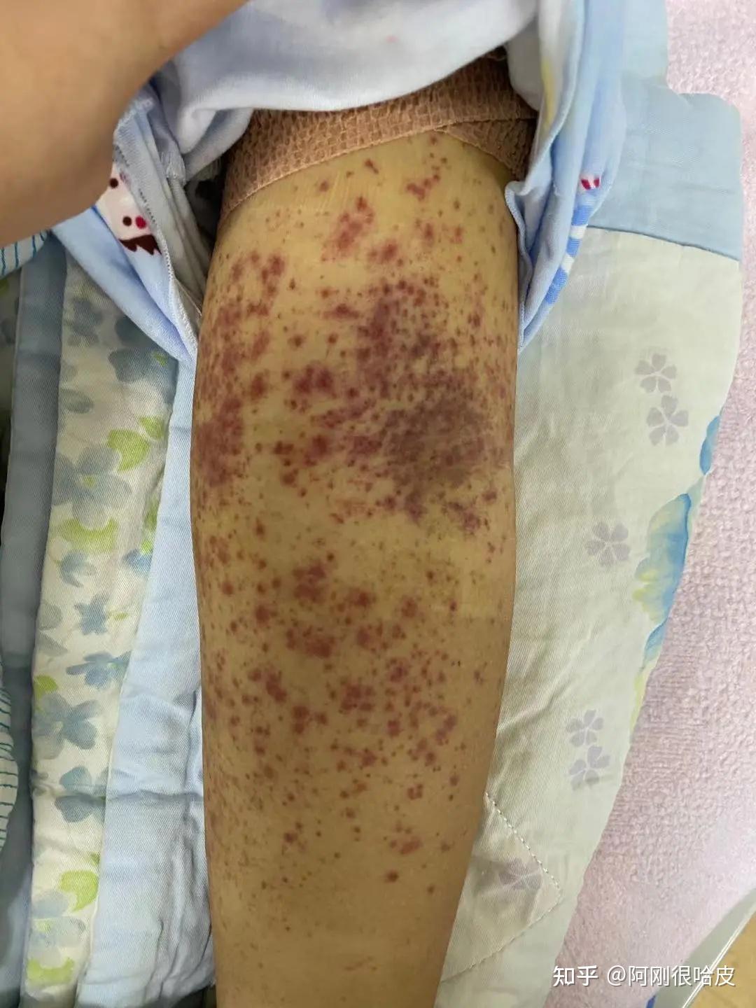 血液感染的症状图片_血液感染有哪些症状_血液感染的图片