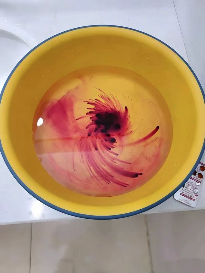 肛瘘术后高锰酸钾坐浴浓度_肛瘘手术高锰酸钾的用多长时间_肛瘘手术高锰酸钾坐浴多久