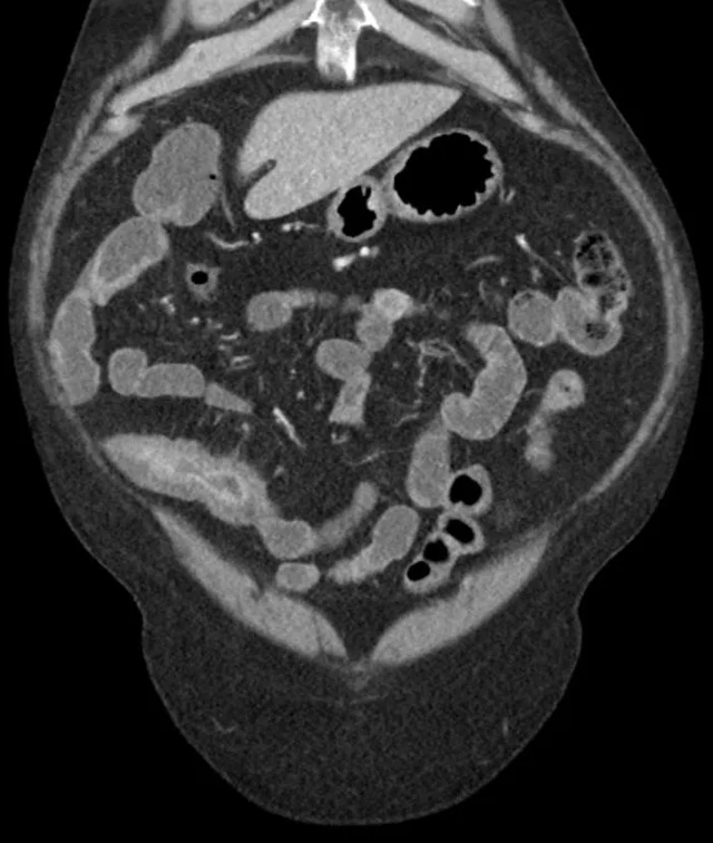 克罗恩病哪家医院看得好-克罗恩病患者的福音！XX 医院治疗经验分享，让生活重燃希望