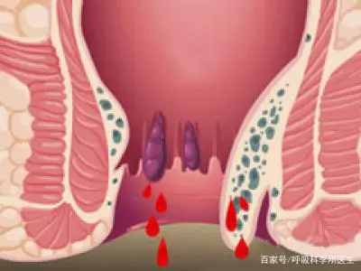 喝酒后大便出血是怎么回事-喝酒后大便出血可不是小事，可能是身体发出的求救信号