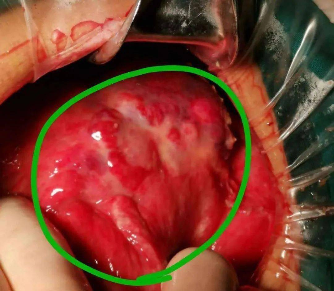 消化道穿孔典型ct图片_消化道穿孔影像学图片_消化道穿孔ct图片