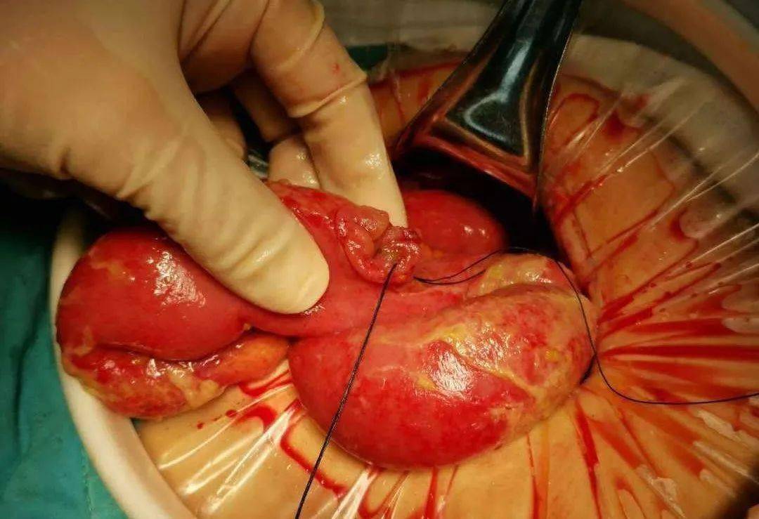 消化道穿孔影像学图片_消化道穿孔典型ct图片_消化道穿孔ct图片