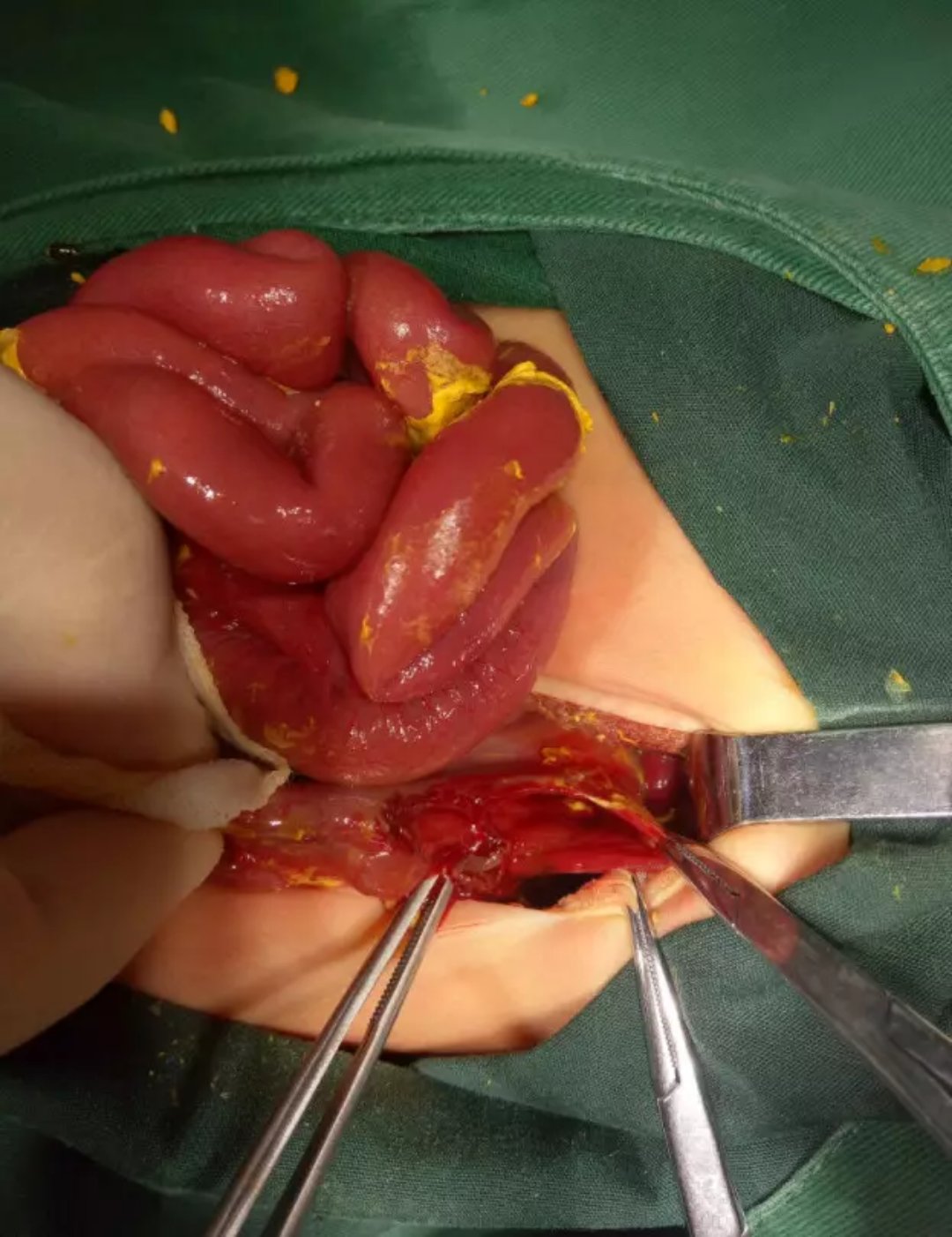 消化道穿孔典型ct图片_消化道穿孔ct图片_消化道穿孔影像学图片