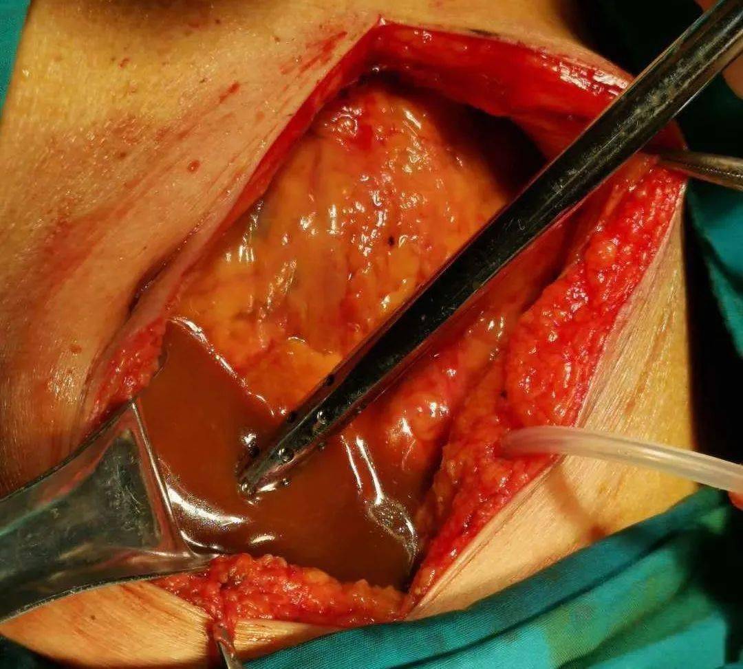 消化道穿孔典型ct图片_消化道穿孔影像学图片_消化道穿孔ct图片