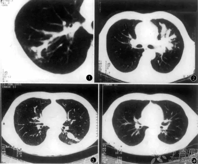 慢性肺炎吃好药能好吗_慢性肺炎吃多久药才会好_慢性肺炎吃什么好
