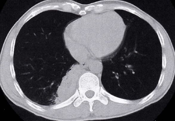 慢性肺炎吃好药能好吗_慢性肺炎吃什么好_慢性肺炎吃多久药才会好