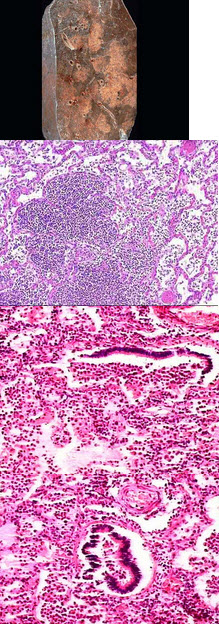 呼吸定义衰竭名词解释_呼吸衰竭如何定义和分类_呼吸衰竭定义