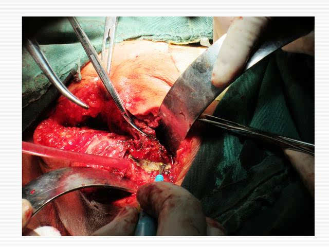 肛瘘手术多久能做_做肛瘘手术后多久可以夫妻同房_做肛瘘手术多长时间能同房