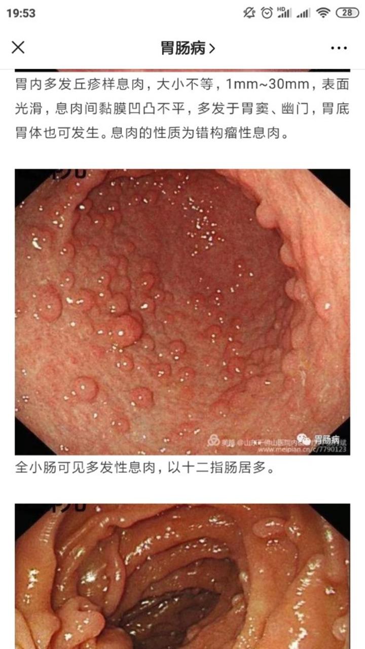 做肛瘘手术多长时间能同房_肛瘘手术多久能做_做肛瘘手术后多久可以夫妻同房