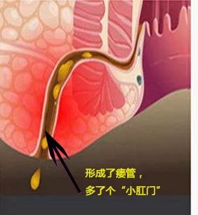 肛瘘手术多久能做_做肛瘘手术多长时间能同房_做肛瘘手术后多久可以夫妻同房