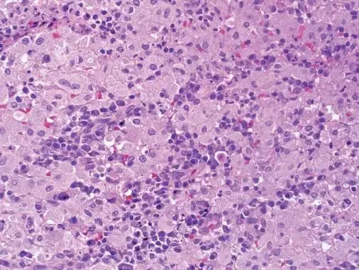 浸润型肺结核难治吗_浸润型肺结核严重吗_肺浸润型肺结核