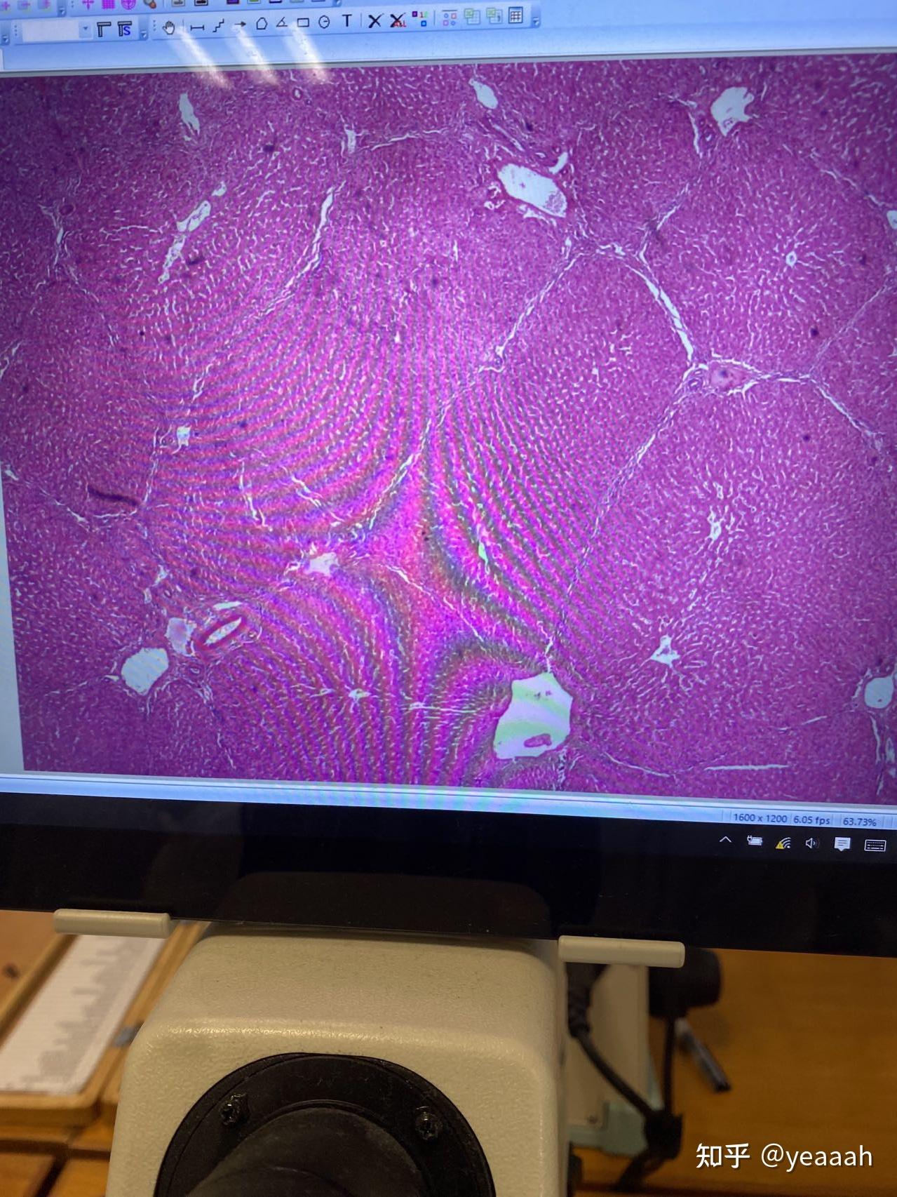 肺浸润型肺结核_浸润型肺结核严重吗_浸润型肺结核难治吗