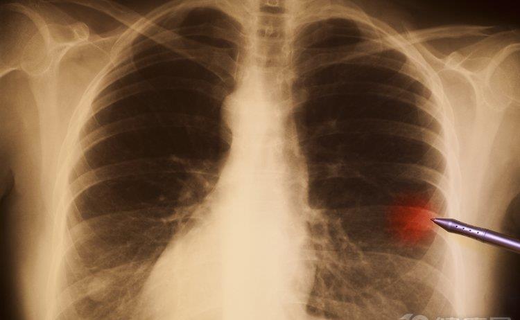 肺癌的后背疼什么症状-后背疼持续不退，警惕肺癌找上门，别错过早期发现机会
