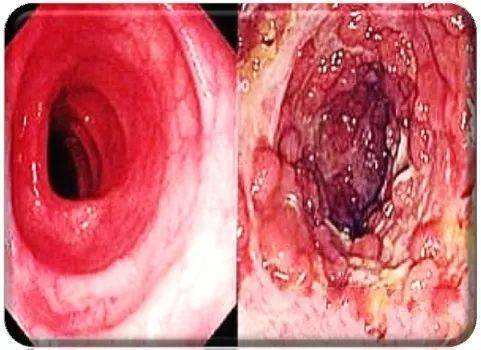 克罗恩病遗传几率高吗_克罗恩病遗传概率_克罗恩病遗传性