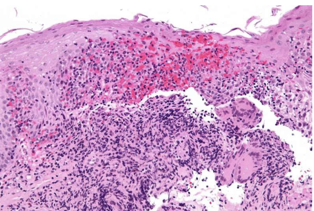 克罗恩病遗传性_克罗恩病遗传概率_克罗恩病遗传几率高吗