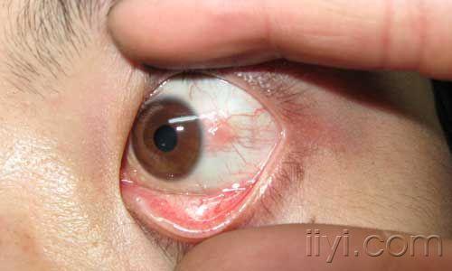 白眼球发蓝是什么_白眼球发蓝是怎么回事_白眼球发蓝好还是发白好