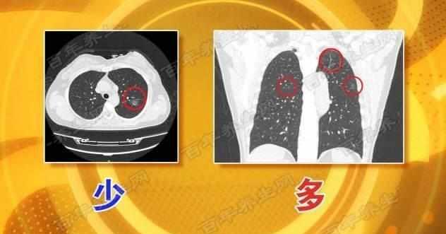 空洞型肺结核严重吗-空洞型肺结核：令人恐惧的肺部疾病，具有传染性且症状严重