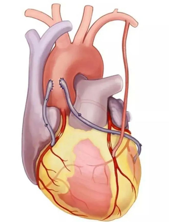 冠心病介入治疗指证_冠心病介入治疗病例_冠心病介入治疗种类及适应症
