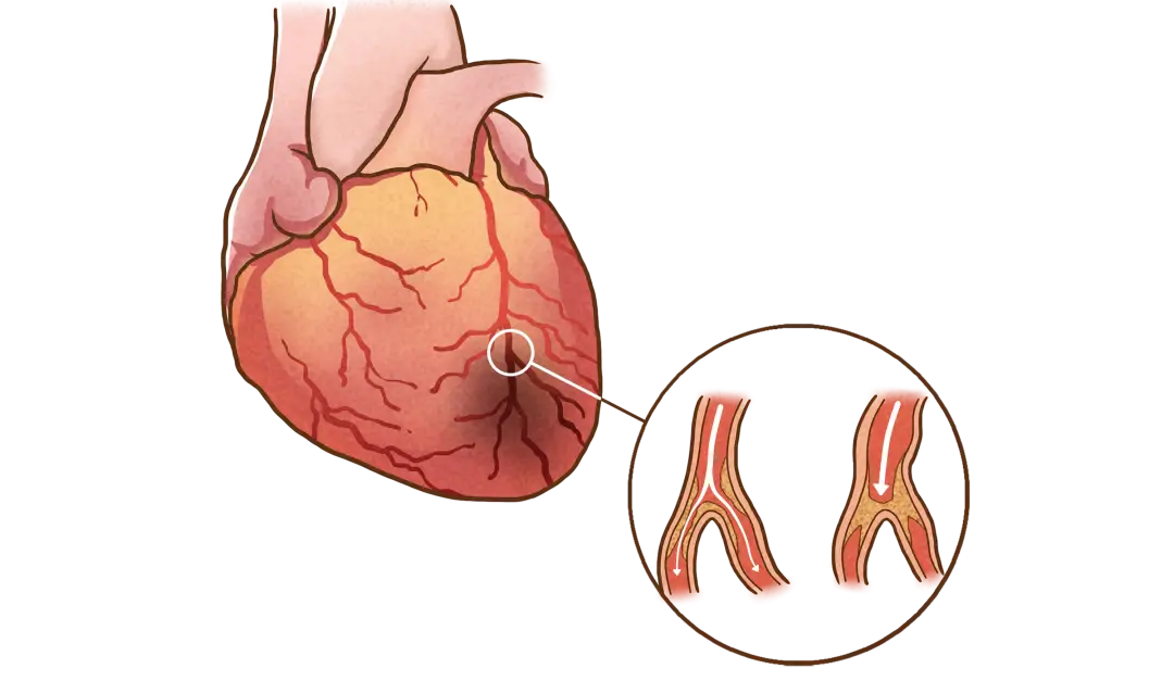 冠心病介入治疗指证_冠心病介入治疗病例_冠心病介入治疗种类及适应症
