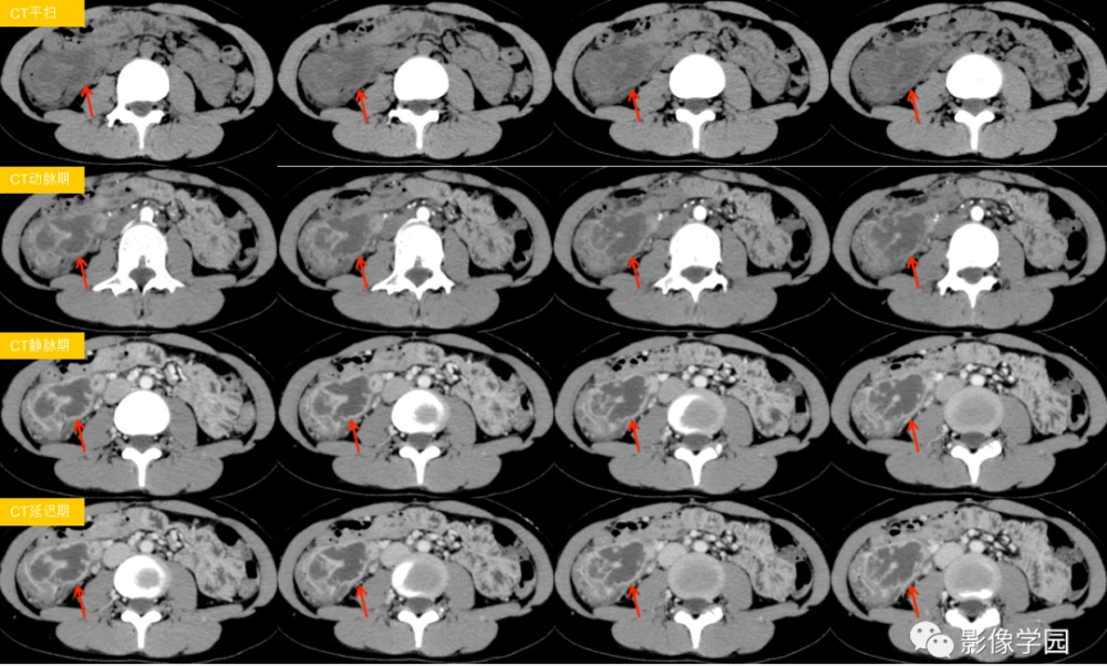 克罗恩病/中西医结合疗法-中西医结合疗法：打败克罗恩病的王牌，让你告别疼痛与不适