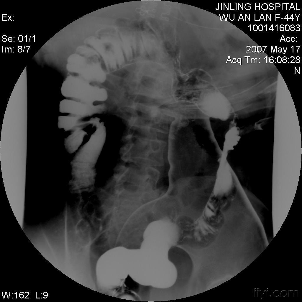 克罗恩的中医疗法_克罗恩病/中西医结合疗法_克罗恩中医治疗原则