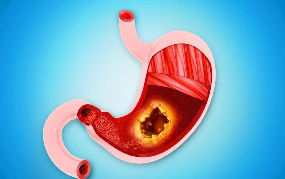 缺少胃酸胃病论坛_缺乏胃酸容易得什么病_缺少胃酸症状是什么