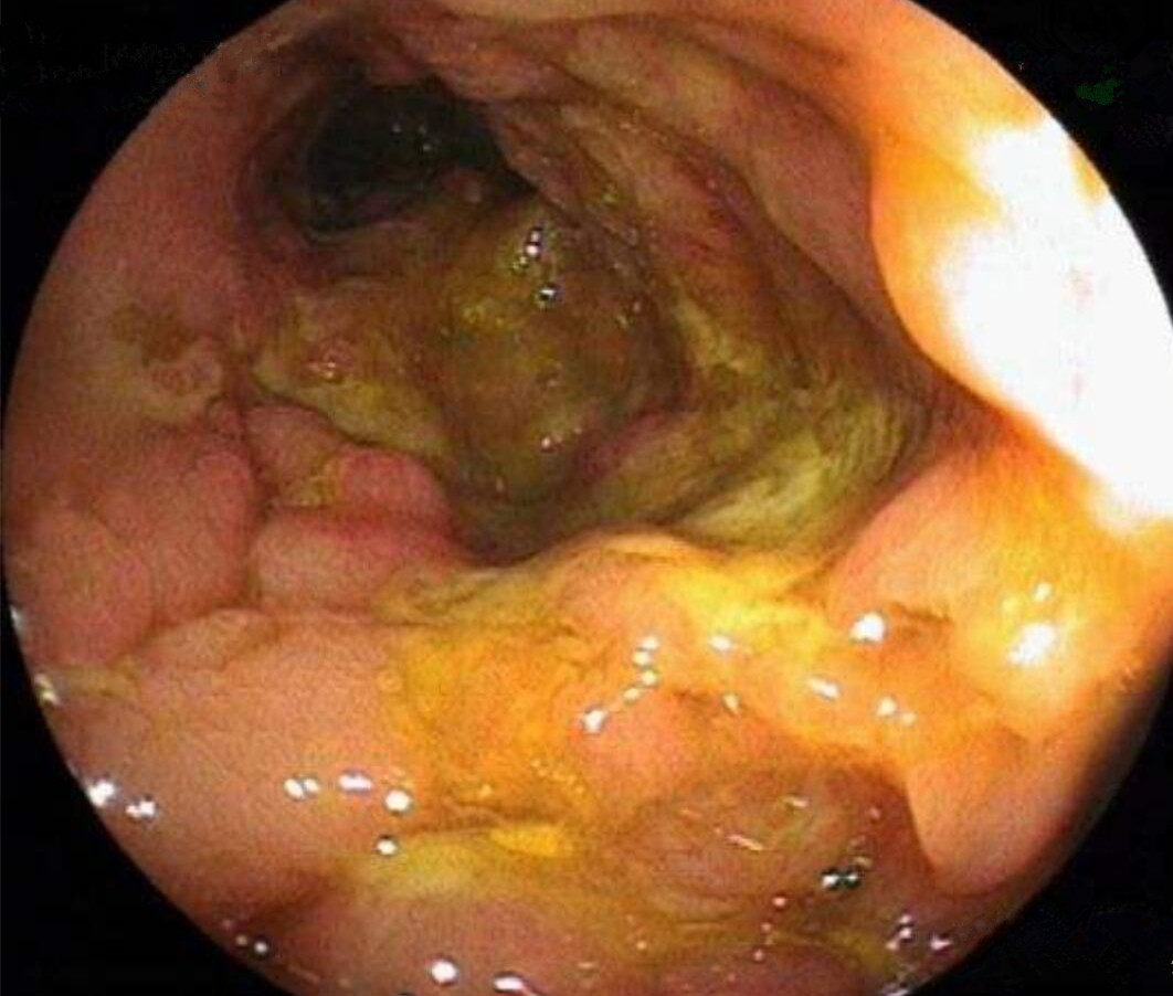 克罗恩膝关节痛_克罗恩关节炎_克罗恩病 关节疼痛