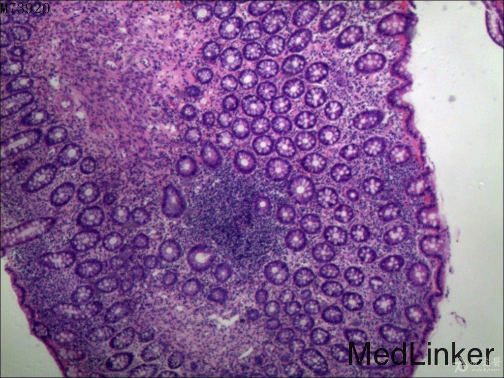 克罗恩病 关节疼痛_克罗恩关节炎症指什么_克罗恩病关节炎