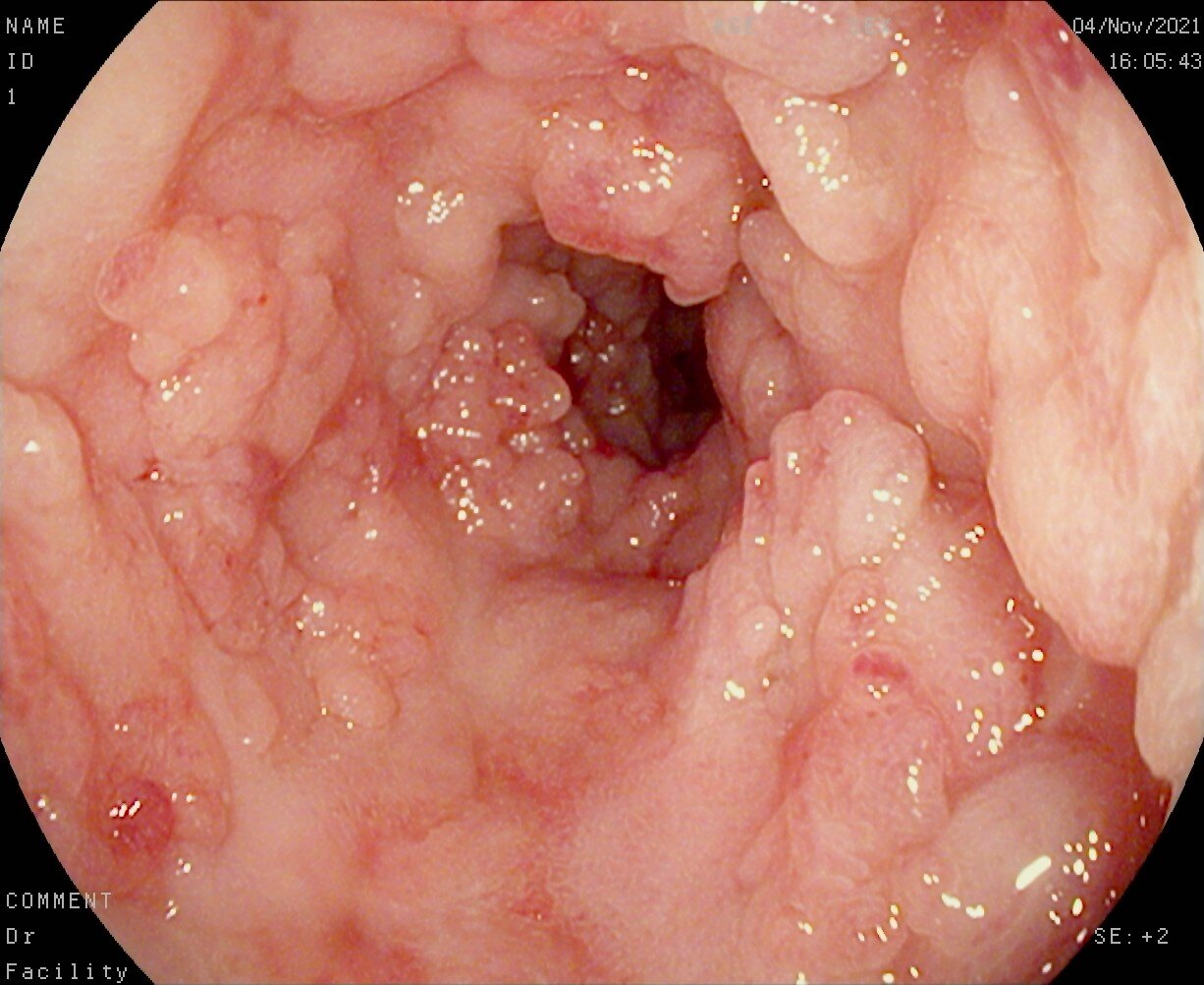 克罗恩病治疗药物_罗克恩病能治好吗_罗克罗恩病