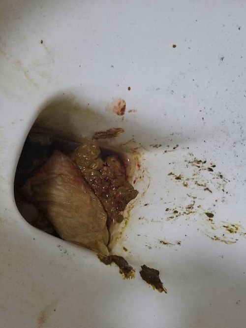 排大便出血是怎么回事_出血大便排回事是痔疮吗_出血大便排回事是什么原因