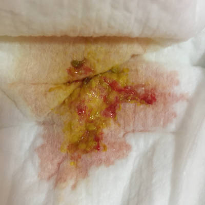 出血大便排回事是痔疮吗_出血大便排回事是什么原因_排大便出血是怎么回事