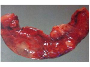 小儿急性阑尾炎的术后护理要点_小儿急性阑尾炎护理病例ppt_小儿急性阑尾炎护理问题