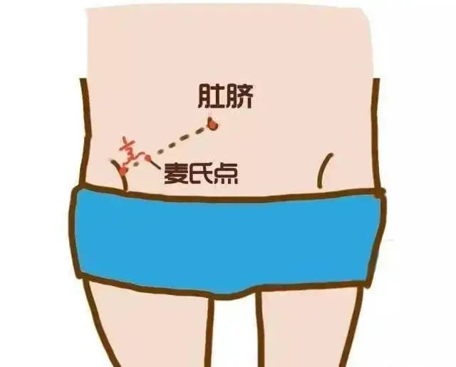 急性盲肠炎避免吃什么_急性盲肠炎不及时治疗_急性盲肠炎吃什么