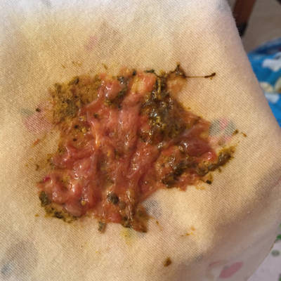 大便时拉出血来_拉大便拉出鲜血_拉大便时只拉出鲜血