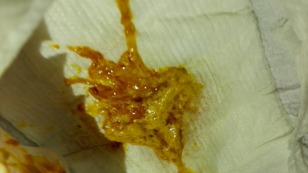 大便时拉出血来_拉大便拉出鲜血_拉大便时只拉出鲜血