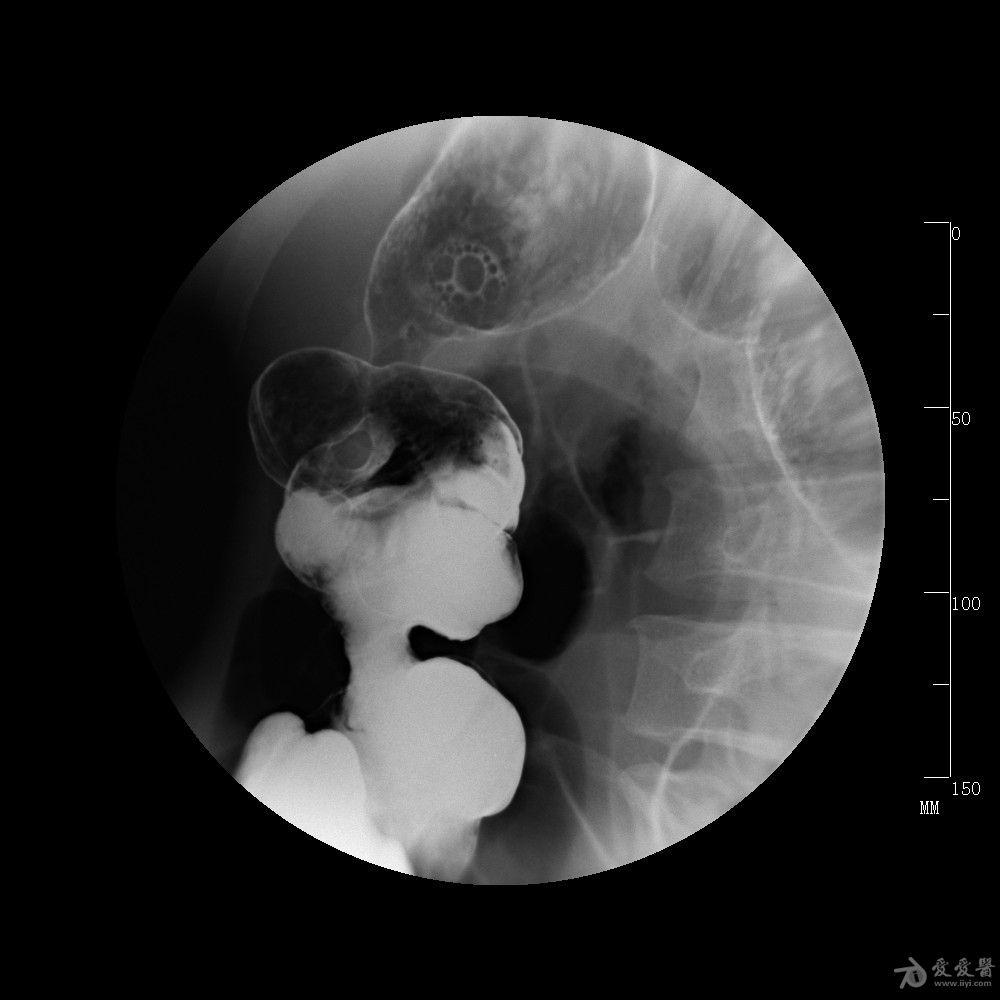 克罗恩病肠镜病理表现_克罗恩病肠镜表现_肠镜克罗恩病