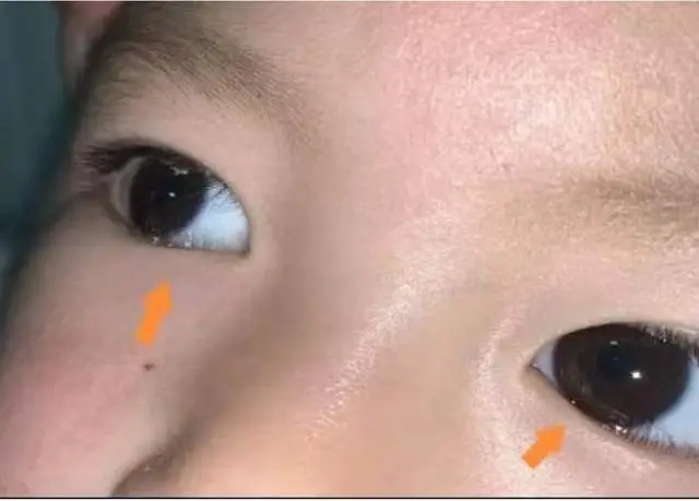 婴儿白眼球蓝色_婴儿白眼球发蓝怎么回事_婴儿白眼珠子发蓝
