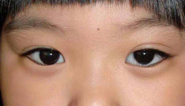 婴儿白眼珠子发蓝_婴儿白眼球蓝色_婴儿白眼球发蓝怎么回事