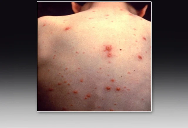 肺炎克雷杆菌白细胞低_肺炎克雷白杆菌的典型临床表现_克雷白杆菌肺炎