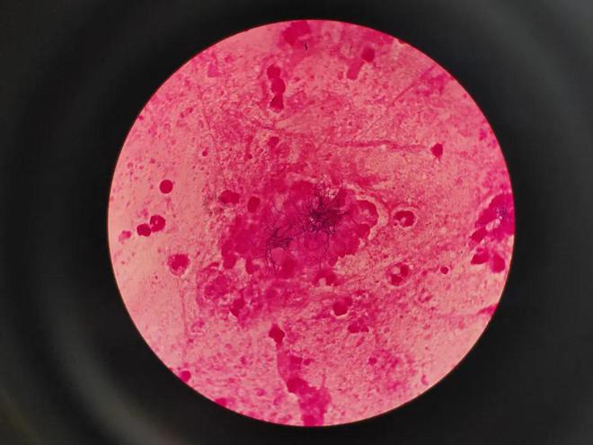 肺炎克雷杆菌白细胞低_肺炎克雷白杆菌的典型临床表现_克雷白杆菌肺炎