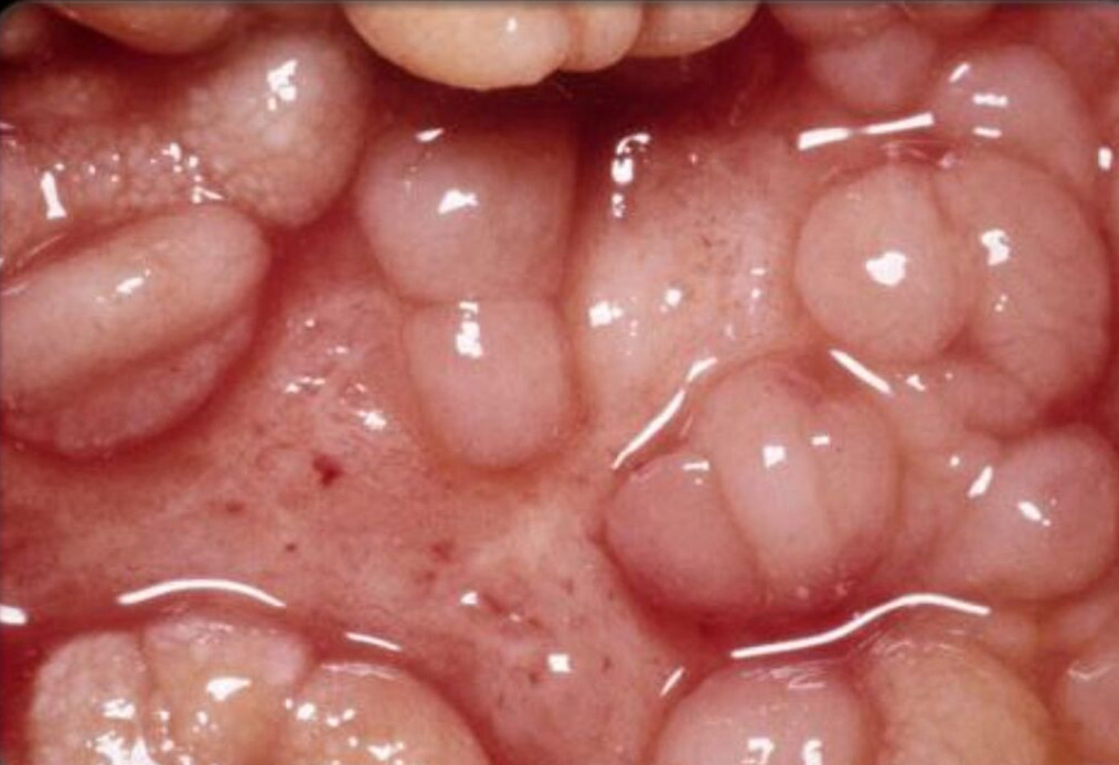 克罗恩病食谱_克罗恩病食谱大全相关的书_克罗恩病食谱app