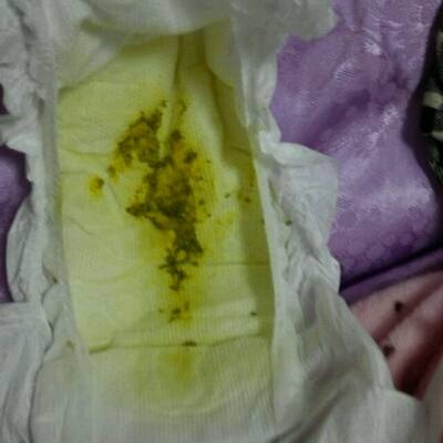 拉大便拉出鲜血_大便拉出鲜血的原因_鲜血原因大便拉出血块