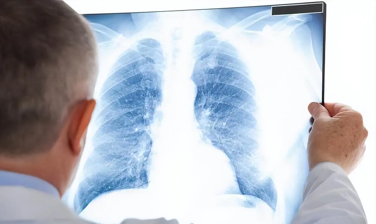 咳嗽白痰多是肺癌吗_咳嗽白痰肺癌_咳嗽白痰肺癌