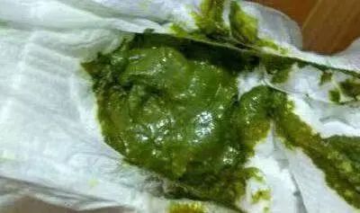 拉大便拉出好多鲜血，我这是得了绝症吗？