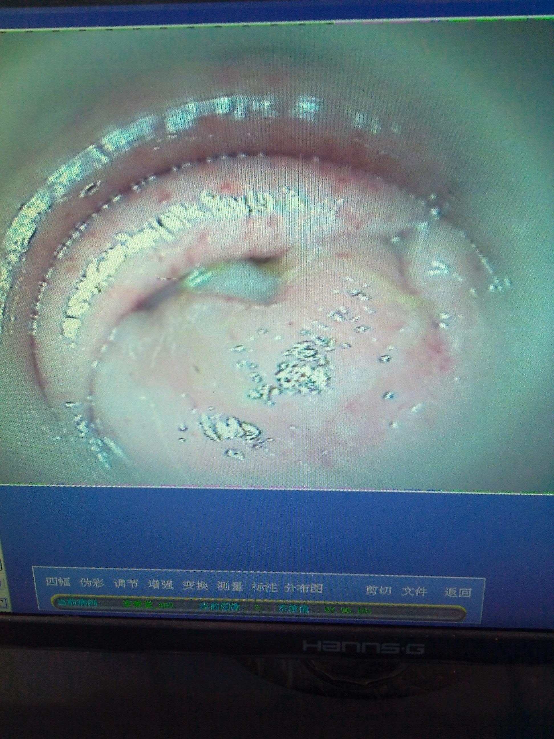 肛门轻度失禁肛门漏气_肛门漏气可以自愈吗_肛门轻度漏气失禁怎么治疗