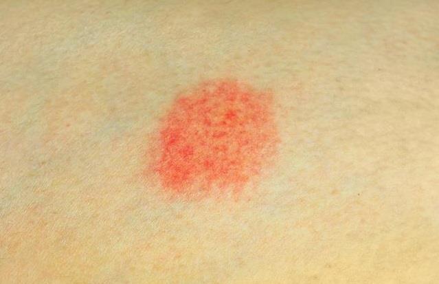 后背疼前胸红痣有点疼_后背疼前胸红痣有什么影响_前胸后背疼有红痣