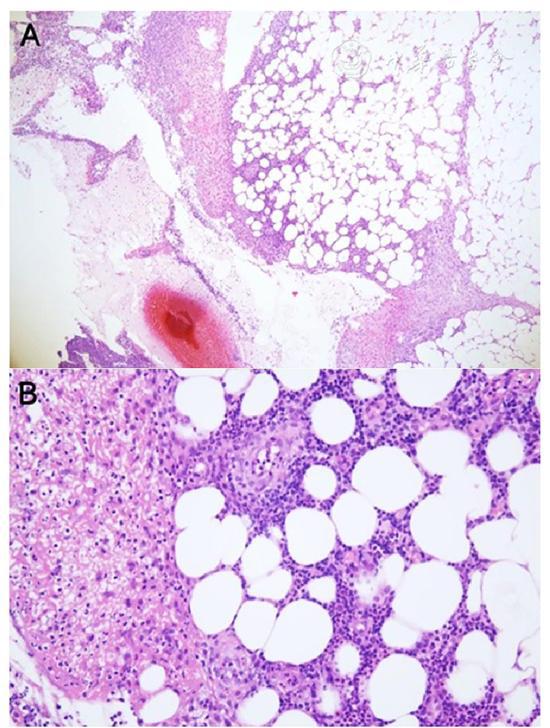 克罗恩类克多少钱-克罗恩病药价高昂，病患家庭压力山大，社会支持亟待加强